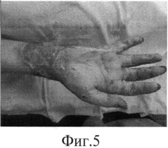 Способ лечения ожогов кисти и профилактики послеожоговых рубцовых деформаций и синдактилий (патент 2559752)