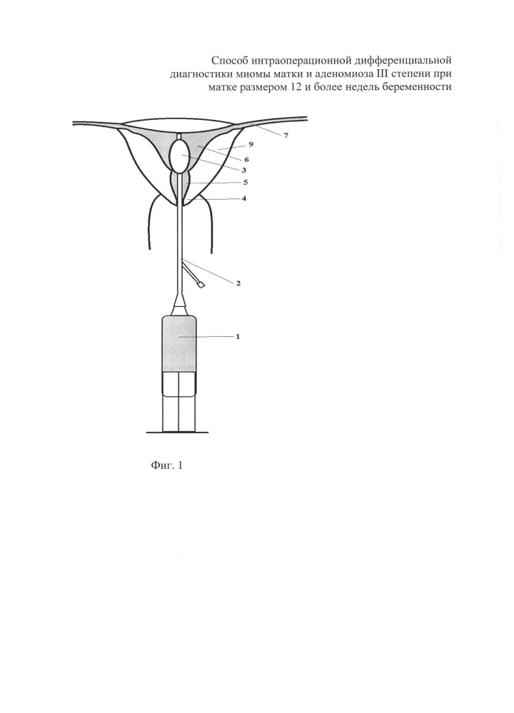 Способ интраоперационной дифференциальной диагностики миомы матки и аденомиоза iii степени при матке размером 12 и более недель беременности (патент 2634420)