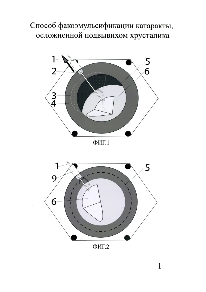 Способ факоэмульсификации катаракты, осложненной подвывихом хрусталика (патент 2664767)