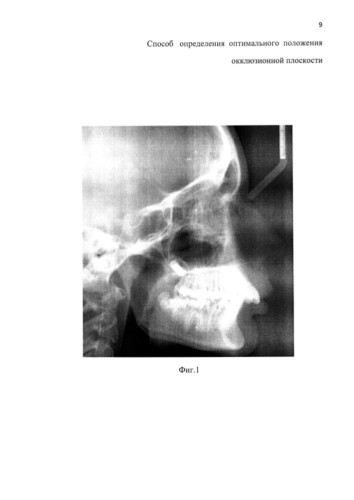 Способ определения оптимального положения окклюзионной плоскости (патент 2610531)