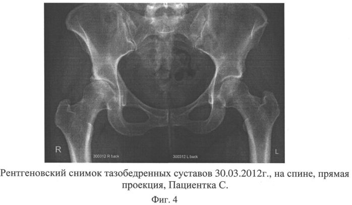 Способ лечения асептического некроза головки бедренной кости и сборы лекарственных растений для осуществления лечения (патент 2558476)