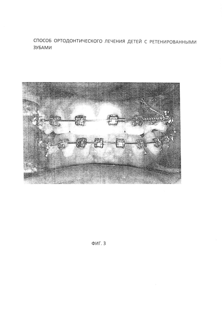 Способ ортодонтического лечения детей с ретенированными зубами (патент 2629061)