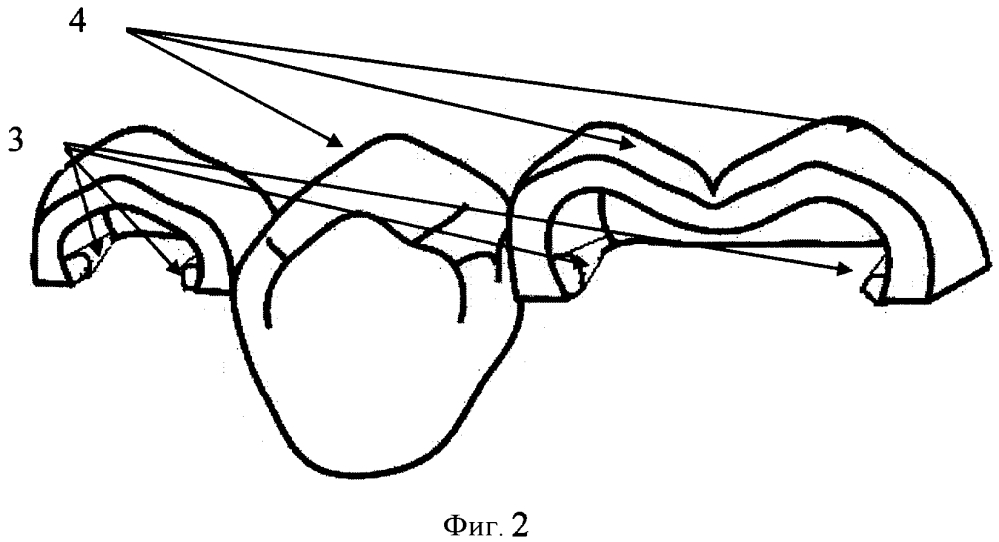 Несъемный зубной протез (патент 2602033)