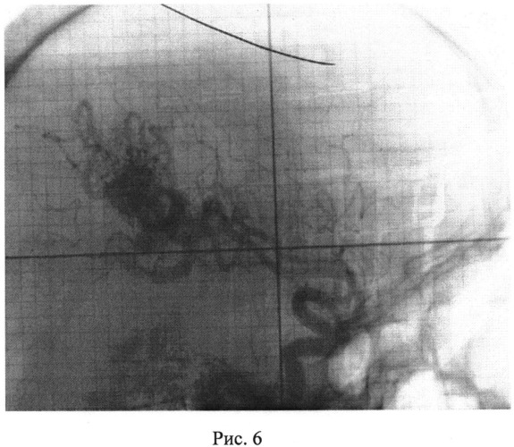 Способ лечения артериовенозных мальформаций головного мозга (патент 2534522)