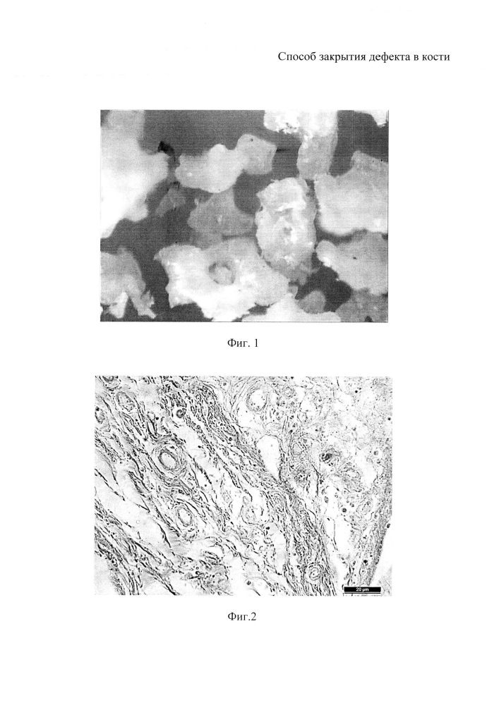 Способ закрытия дефекта в кости (патент 2644828)