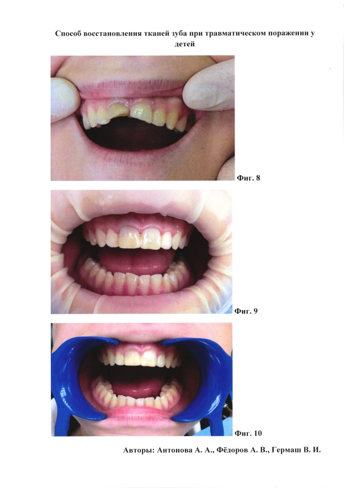 Способ восстановления тканей зуба при травматическом поражении у детей (патент 2604387)