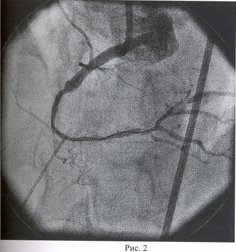 Способ коррекции окклюзии коронарной артерии (патент 2456934)