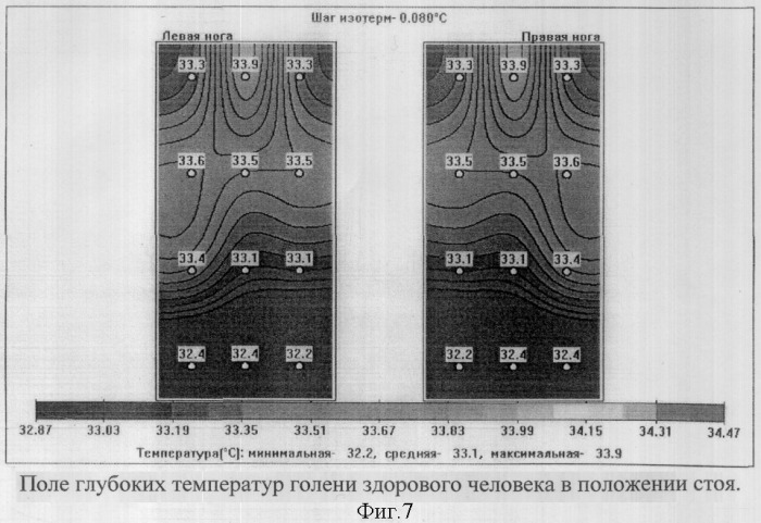 Способ комбинированной термометрии для диагностики посттромботической болезни вен нижних конечностей (патент 2319438)