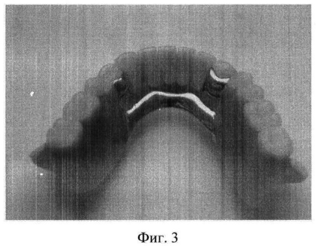 Способ восстановления ретенционных свойств зубных протезов (патент 2463992)