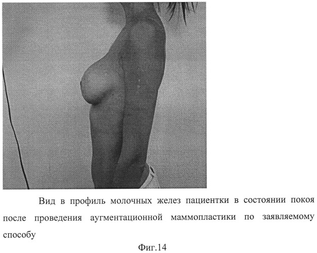 Способ формирования кармана для имплантата в двойственной плоскости при аугментационной маммопластике (патент 2498777)