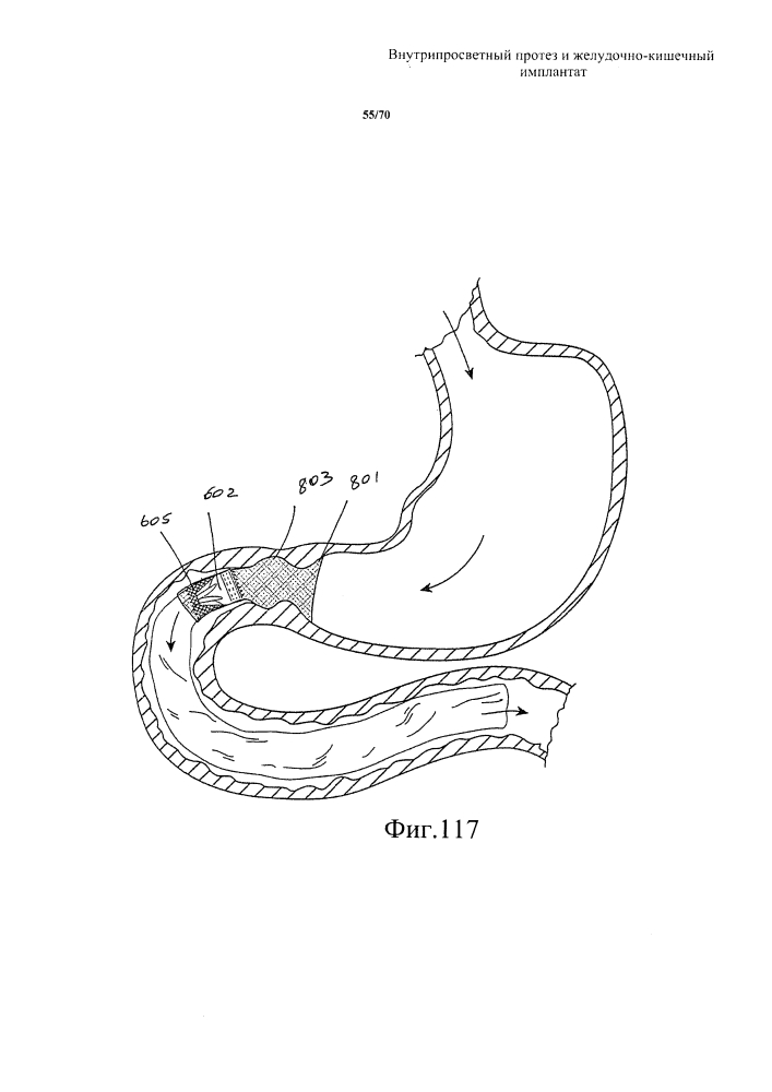 Внутрипросветный протез и желудочно-кишечный имплантат (патент 2626885)