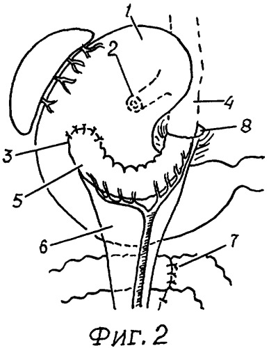 Способ наложения заднего толстокишечно-желудочного анастомоза при эзофагопластике (патент 2344769)