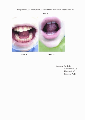 Устройство для измерения длины части уздечки языка (патент 2579279)