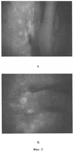 Способ диагностики и фотодинамической терапии угревой сыпи (acne vulgaris) (патент 2265463)