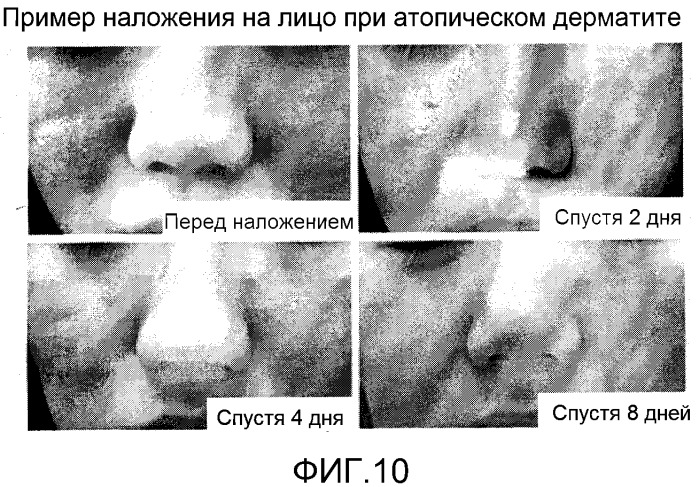 Повязка для лечения кожных заболеваний и облегчения симптомов кожных болезней, вызывающих экссудацию белков крови (патент 2524628)