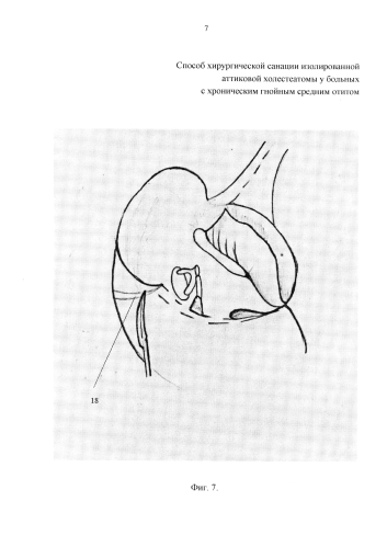 Способ хирургической санации изолированной аттиковой холестеатомы у больных с хроническим гнойным средним отитом (патент 2580041)