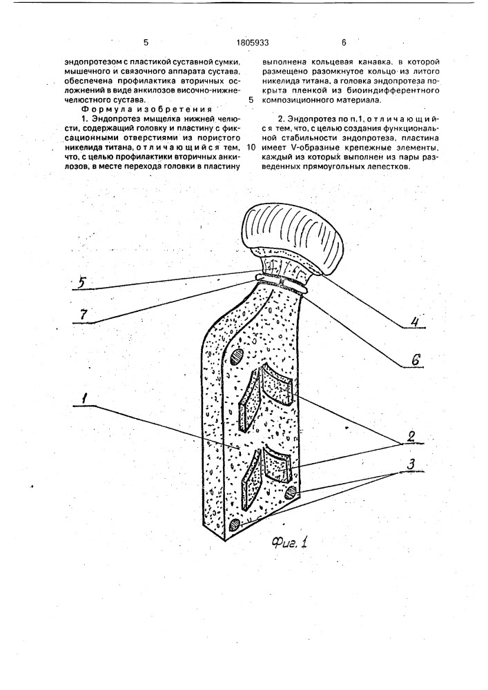 Эндопротез мыщелка нижней челюсти (патент 1805933)