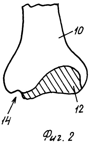 Костный материал и коллагеновая композиция для восстановления поврежденных суставов (патент 2292858)