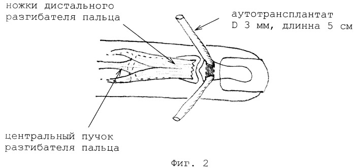 Способ аутопластики сухожилия дистального разгибателя пальца кисти (патент 2353319)