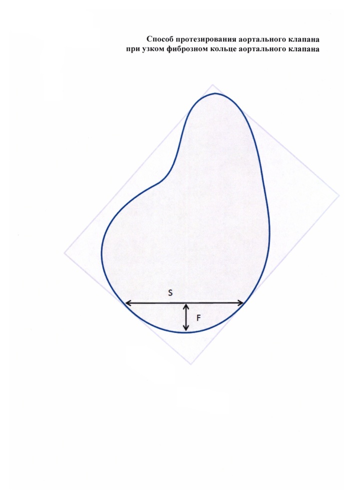 Способ протезирования аортального клапана при узком фиброзном кольце аортального клапана (патент 2622450)