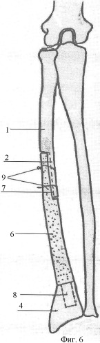 Способ хирургического лечения сегментарных дефектов диафизов костей предплечья (патент 2358677)
