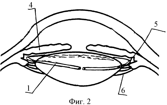 Имплантат для хирургического лечения пресбиопии и способ его имплантации (патент 2329019)