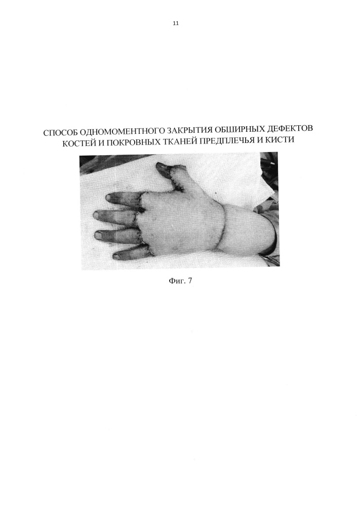 Способ одномоментного закрытия обширных дефектов костей и покровных тканей предплечья и кисти (патент 2645973)