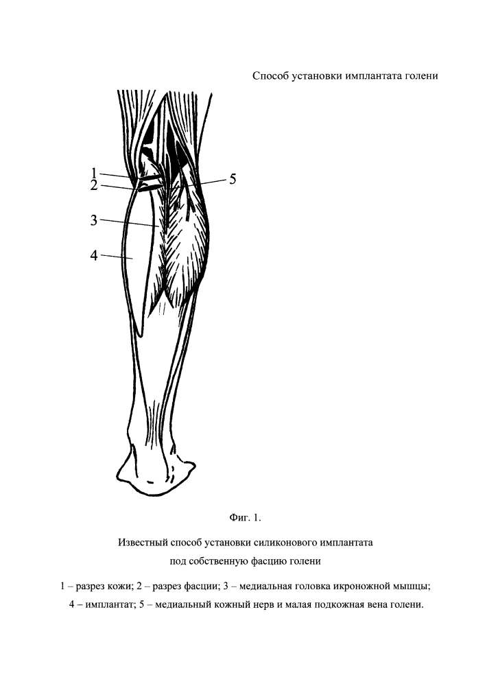 Способ установки имплантата голени (патент 2626267)