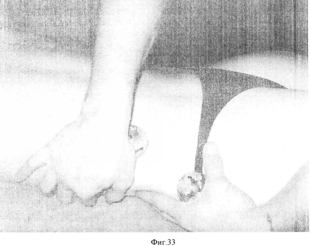 Способ моделирования фигуры при консервативном лечении ожирения (патент 2364387)