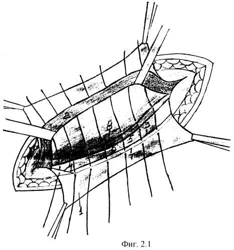 Модифицированная пластика задней стенки пахового канала при грыжесечении (патент 2294699)