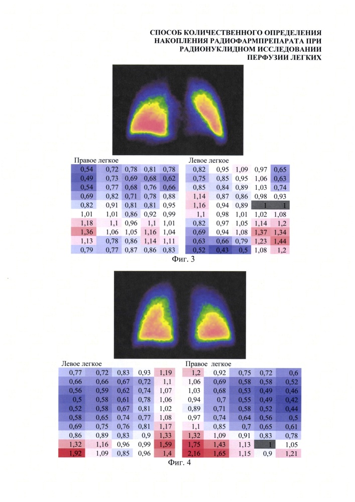 Способ количественного определения накопления радиофармпрепарата при радионуклидном исследовании перфузии легких (патент 2629044)