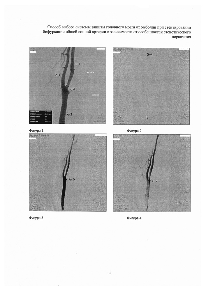 Способ выбора системы защиты головного мозга от эмболии при стентировании бифуркации общей сонной артерии в зависимости от особенностей стенотического поражения (патент 2609206)