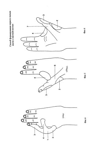 Способ формирования первого пальца кисти с пястной костью (патент 2577948)