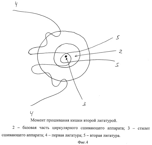 Способ формирования аппаратного колоректального анастомоза (патент 2476160)