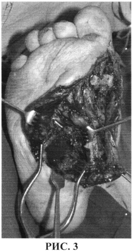 Способ хирургического лечения диабетической остеоартропатии среднего отдела стопы в стадии гнойных осложнений (патент 2561286)