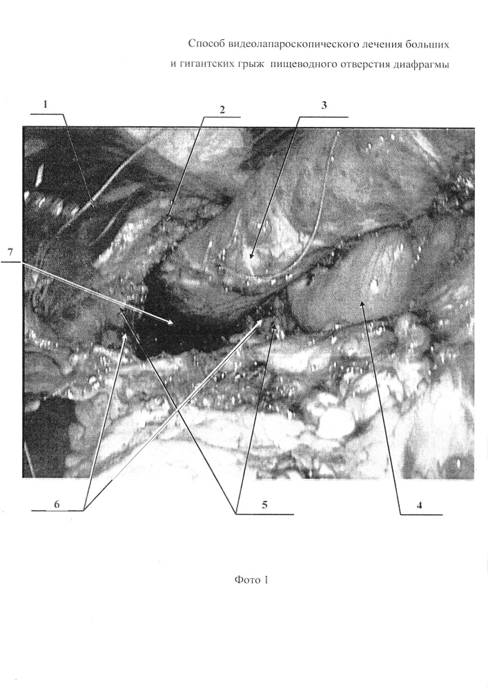 Способ видеолапароскопического лечения больших и гигантских грыж пищеводного отверстия диафрагмы (патент 2627601)