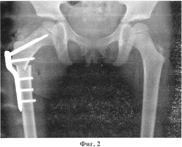 Способ хирургического лечения деформаций проксимального отдела бедра у детей (патент 2570046)