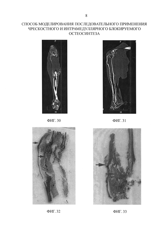 Способ моделирования последовательного применения чрескостного и интрамедуллярного блокируемого остеосинтеза (патент 2593583)