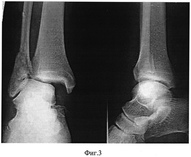 Способ лечения застарелых неправильно сросшихся пронационно-эверсионных переломов дистального отдела костей голени (патент 2528819)