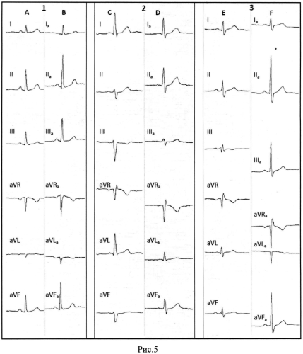 Способ выбора точек для аппроксимированных отведений электрокардиограммы (патент 2571709)