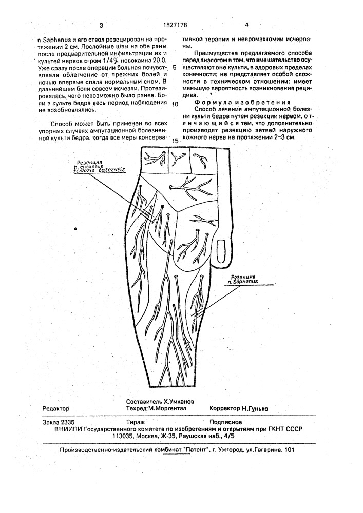 Способ лечения ампутационной болезни культи бедра (патент 1827178)