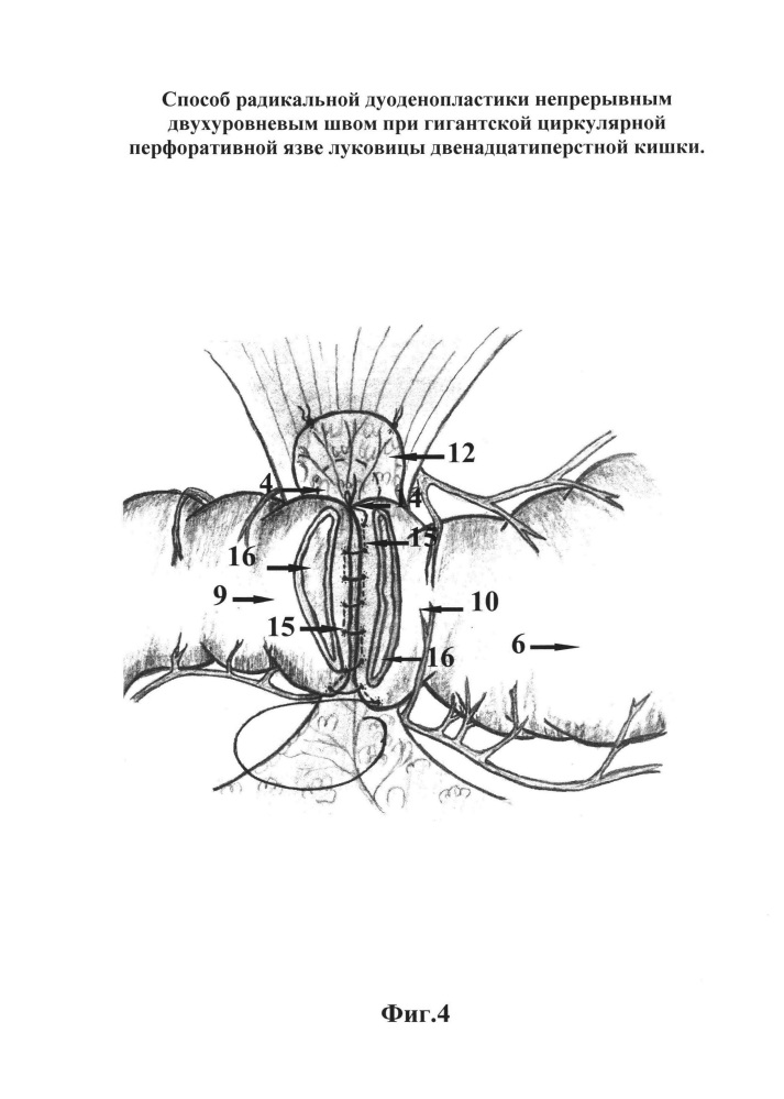 Способ радикальной дуоденопластики непрерывным двухуровневым швом при гигантской циркулярной перфоративной язве луковицы двенадцатиперстной кишки (патент 2664176)