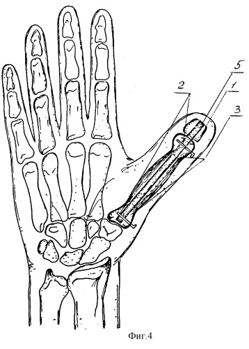 Способ дистракционного удлинения пястной кости при наличии ее культи или короткой культи основной фаланги (патент 2260394)