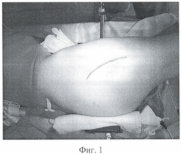 Способ эндопротезирования больных коксартрозом с сопутствующей наружной ротационной контрактурой тазобедренного сустава 2-3-й степени (патент 2432133)