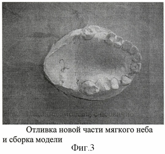 Способ изготовления разборной модели для протезов мягкого неба (патент 2406464)