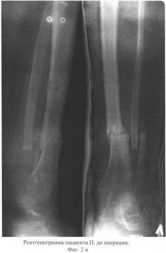 Способ лечения несросшихся переломов и ложных суставов костей голени, осложненных хроническим травматическим остеомиелитом (патент 2311144)