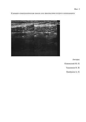 Клинико-соноскопическая шкала для диагностики острого аппендицита (патент 2587649)
