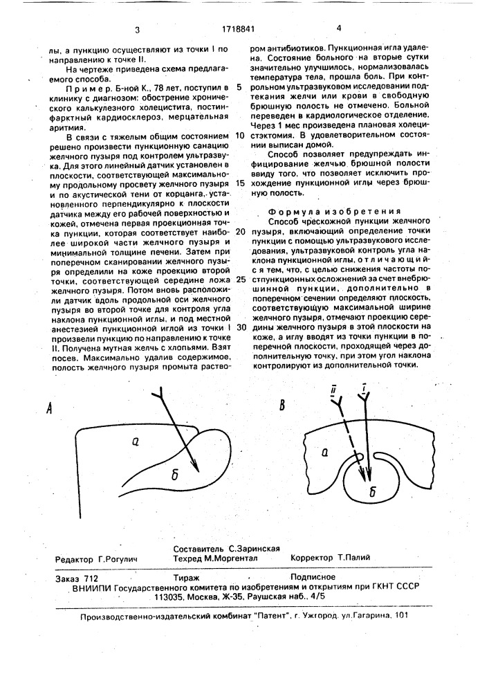 Способ чрескожной пункции желчного пузыря (патент 1718841)