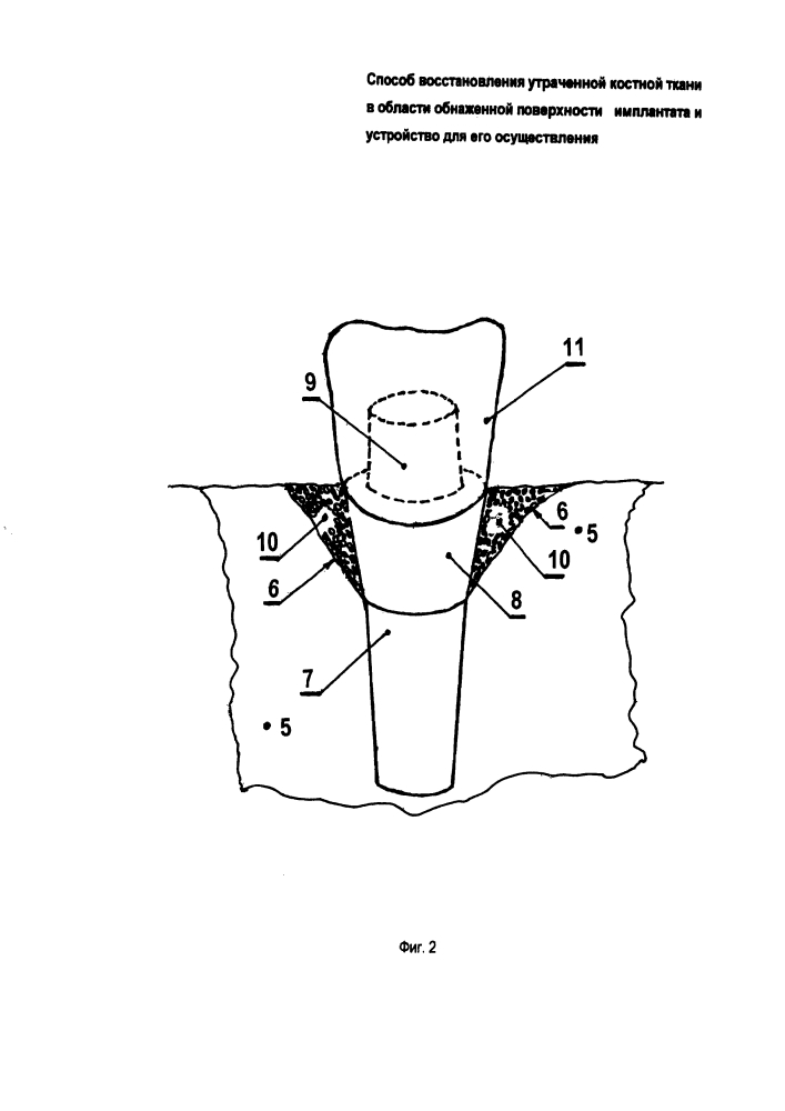 Устройство для восстановления утраченной костной ткани вокруг обнаженной поверхности имплантата и способ его использования (патент 2604049)