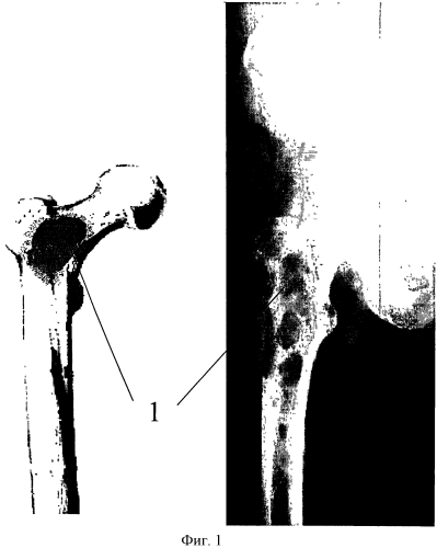 Способ профилактической фиксации проксимального отдела бедренной кости с цементной пластикой после радиочастотной абляции при метастатическом поражении и угрозе патологического перелома (патент 2553497)